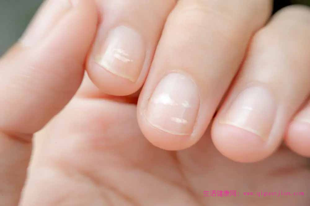指甲白点≠缺钙!一文读懂指甲“健康密码”,缺啥一看便知